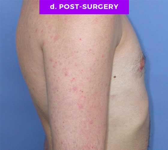 FEMALE-TO-MALE CHEST CONTOURING Patient 5 After 2