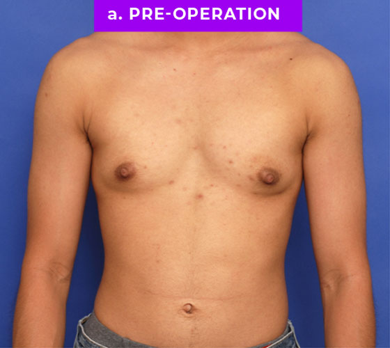 FEMALE-TO-MALE CHEST CONTOURING Patient 8 Before