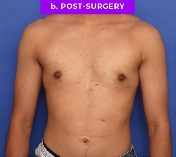 FEMALE-TO-MALE CHEST CONTOURING Patient 8 After