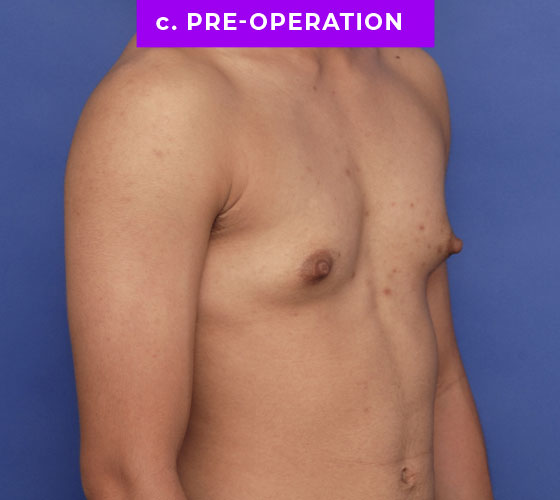 FEMALE-TO-MALE CHEST CONTOURING Patient 8 Before 2