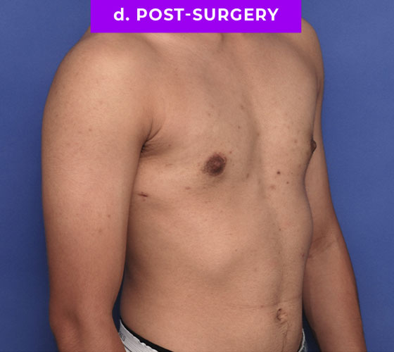 FEMALE-TO-MALE CHEST CONTOURING Patient 8 After 2