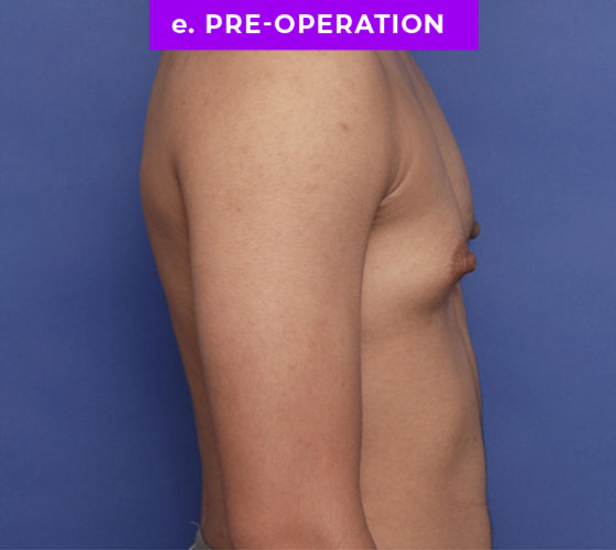 FEMALE-TO-MALE CHEST CONTOURING Patient 8 Before 3