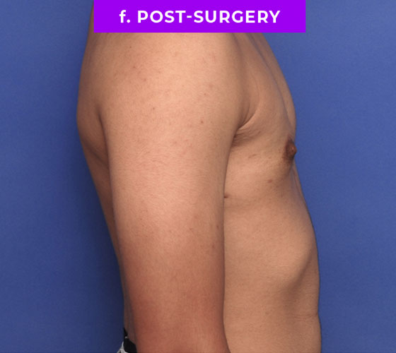 FEMALE-TO-MALE CHEST CONTOURING Patient 8 After 3