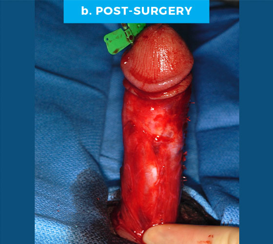 CONGENITAL PENILE CURVATURE Patient 10 After