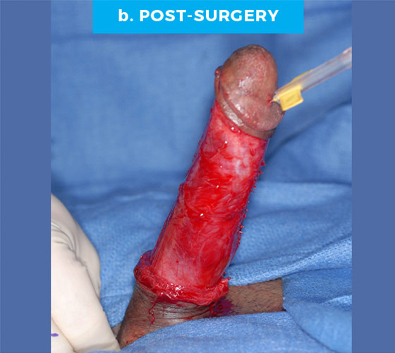 CONGENITAL PENILE CURVATURE Patient 11 After