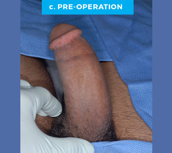 CONGENITAL PENILE CURVATURE Patient 11 Before 2