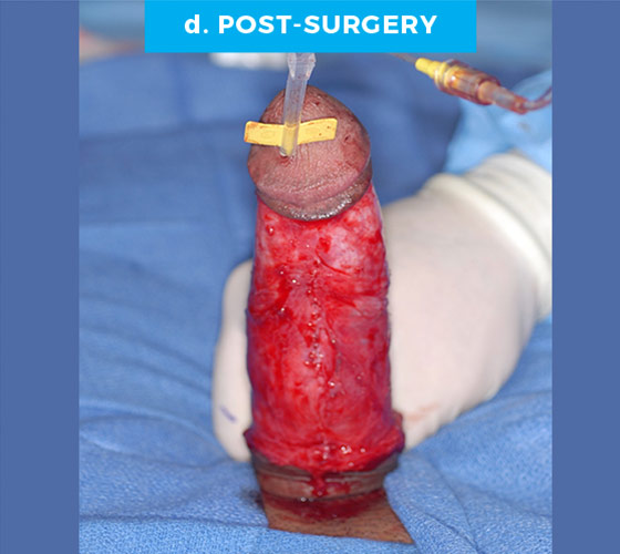 CONGENITAL PENILE CURVATURE Patient 11 After 2