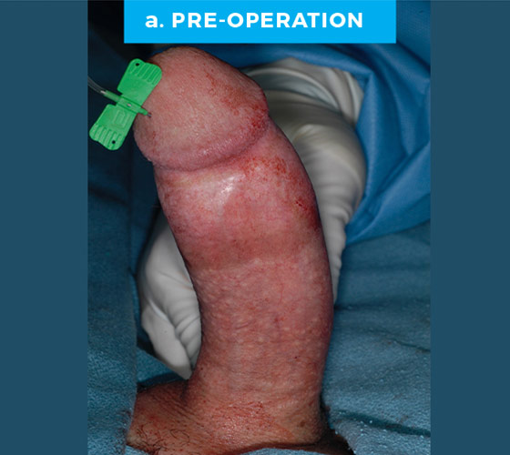 CONGENITAL PENILE CURVATURE Patient 12 Before