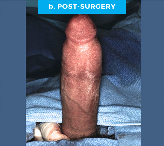 CONGENITAL PENILE CURVATURE Patient 13 After
