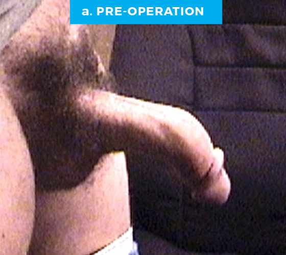 CONGENITAL PENILE CURVATURE Patient 2 Before