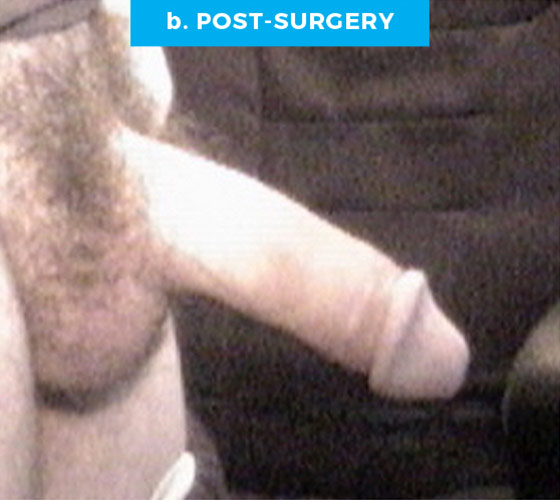 CONGENITAL PENILE CURVATURE Patient 2 After
