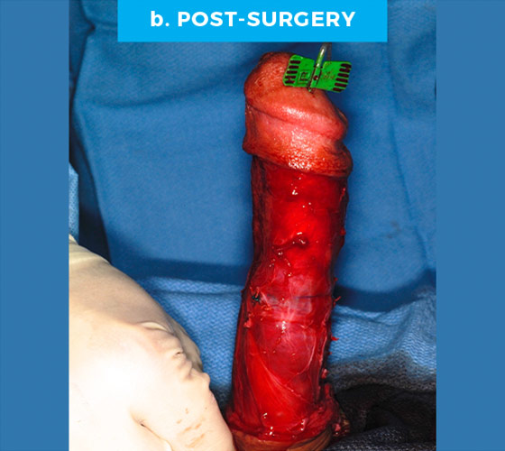 CONGENITAL PENILE CURVATURE Patient 3 After