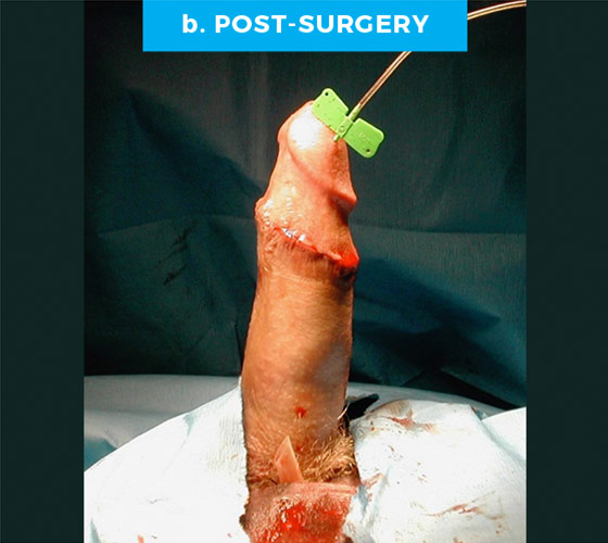 CONGENITAL PENILE CURVATURE Patient 4 After