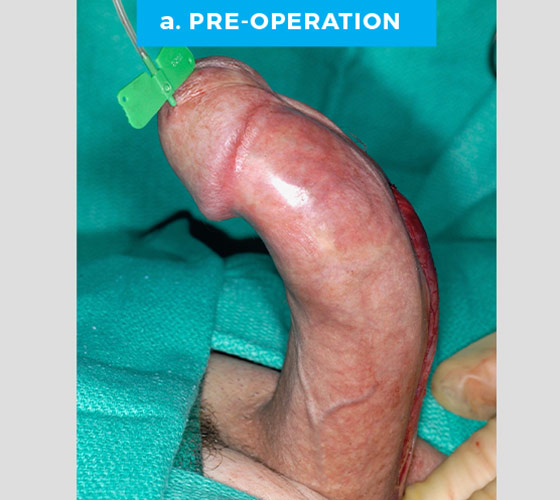 CONGENITAL PENILE CURVATURE Patient 5 Before
