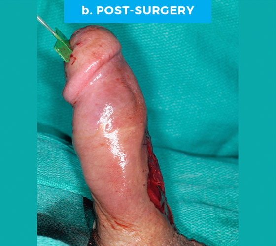CONGENITAL PENILE CURVATURE Patient 5 After