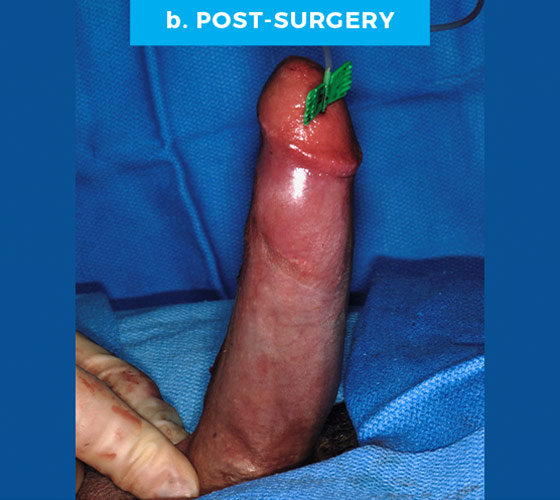 CONGENITAL PENILE CURVATURE Patient 6 After
