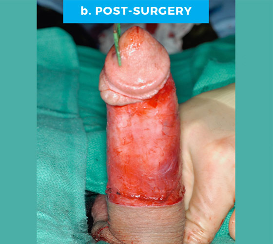 CONGENITAL PENILE CURVATURE Patient 7 After
