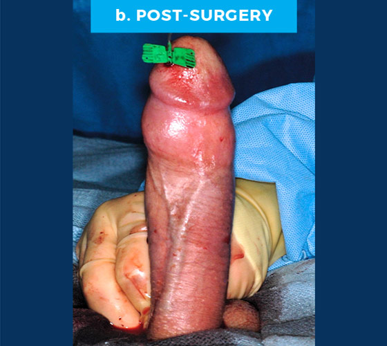 CONGENITAL PENILE CURVATURE Patient 8 After