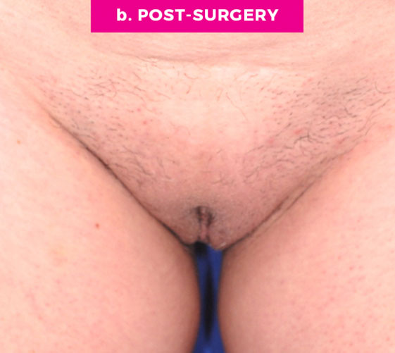 COMBINATION FEMALE GENITAL SURGERIES Patient 2 After