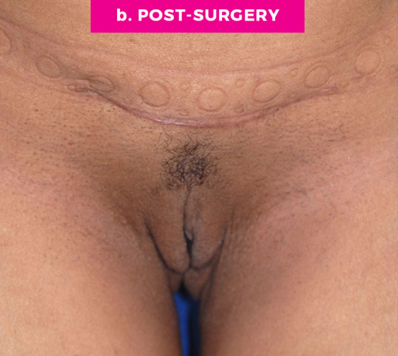 COMBINATION FEMALE GENITAL SURGERIES Patient 3 After