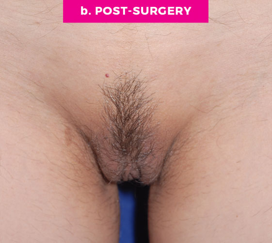 COMBINATION FEMALE GENITAL SURGERIES Patient 4 After