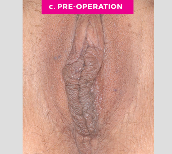 COMBINATION FEMALE GENITAL SURGERIES Patient 4 Before 2