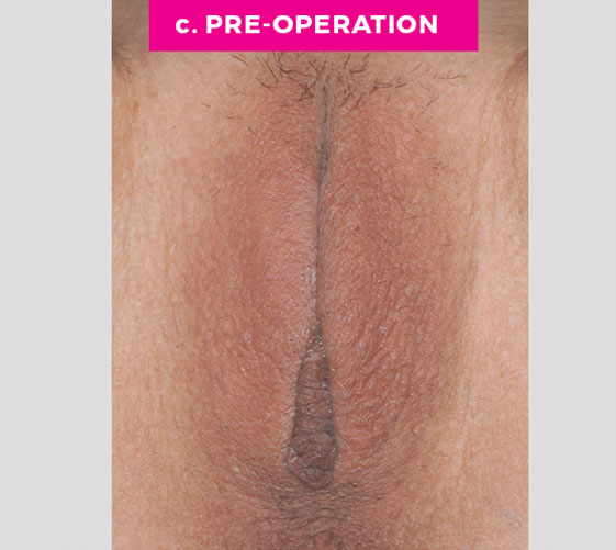 COMBINATION FEMALE GENITAL SURGERIES Patient 5 Before 2