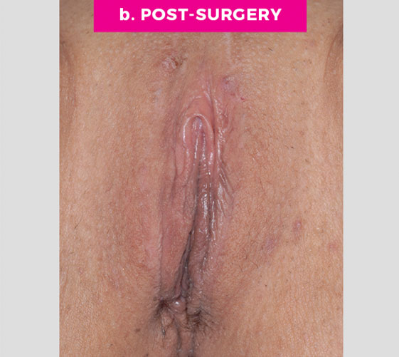 COMBINATION FEMALE GENITAL SURGERIES Patient 6 After