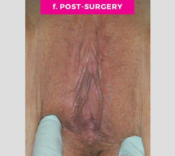 COMBINATION FEMALE GENITAL SURGERIES Patient 7 After 3