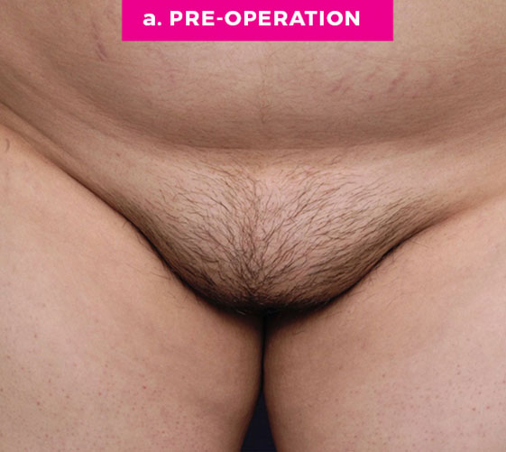 PUBIC MONS LIFT Patient 6 Before