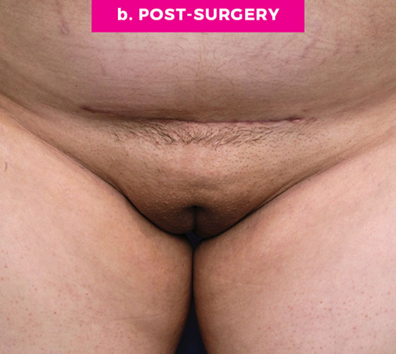PUBIC MONS LIFT Patient 6 After