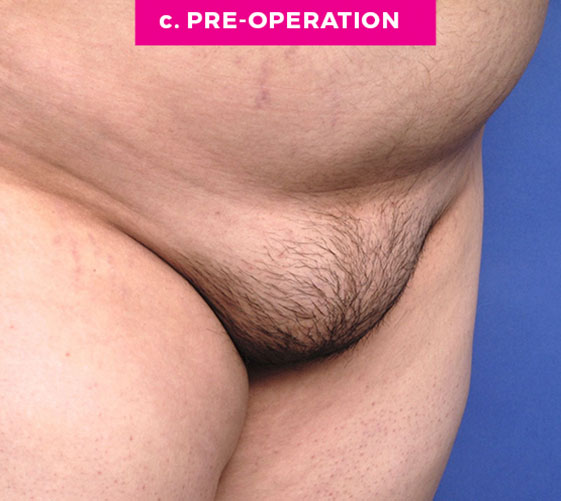 PUBIC MONS LIFT Patient 6 Before 2