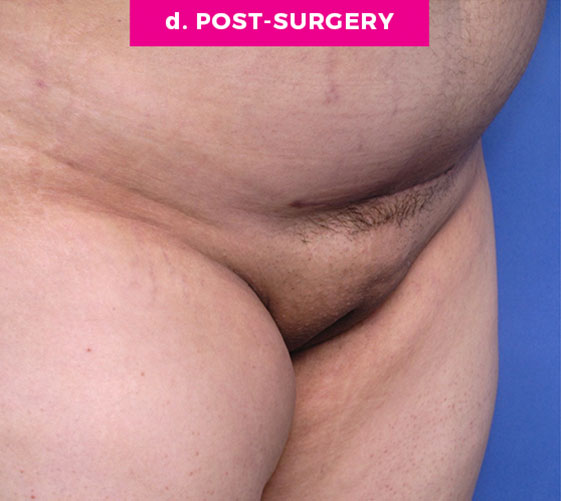 PUBIC MONS LIFT Patient 6 After 2