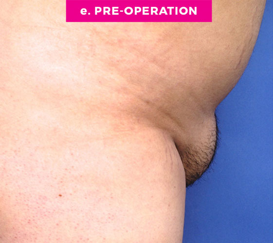 PUBIC MONS LIFT Patient 6 Before 3