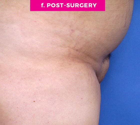 PUBIC MONS LIFT Patient 6 After 3