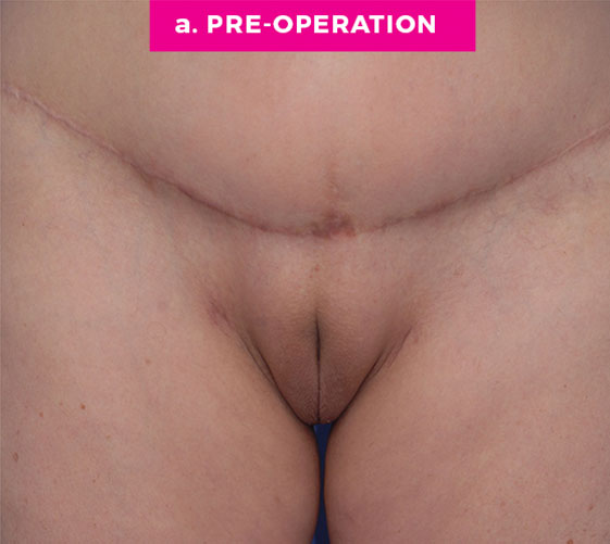 PUBIC MONS LIFT Patient 7 Before