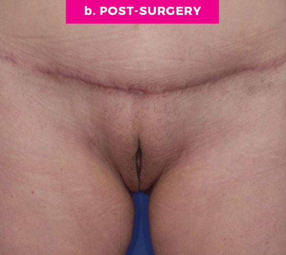 PUBIC MONS LIFT Patient 7 After