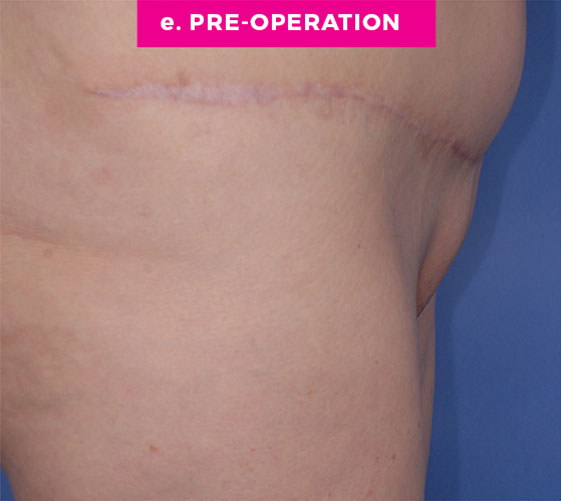 PUBIC MONS LIFT Patient 7 Before 3
