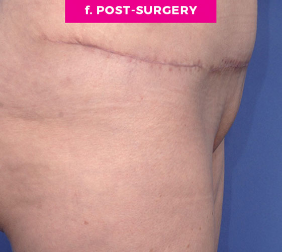 PUBIC MONS LIFT Patient 7 After 3