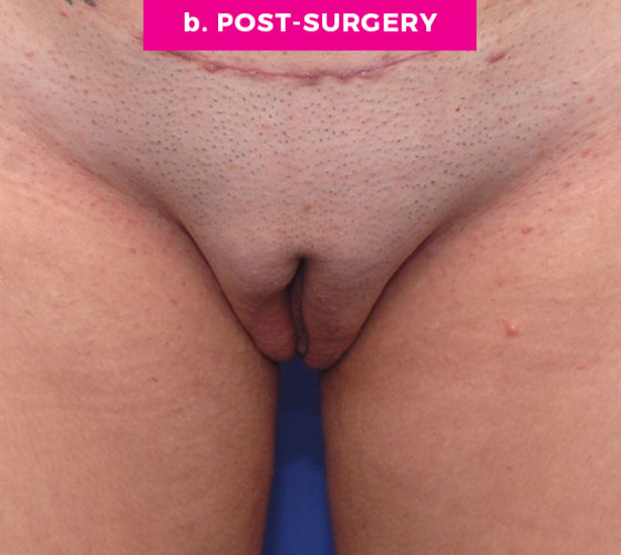 PUBIC MONS LIFT Patient 8 After