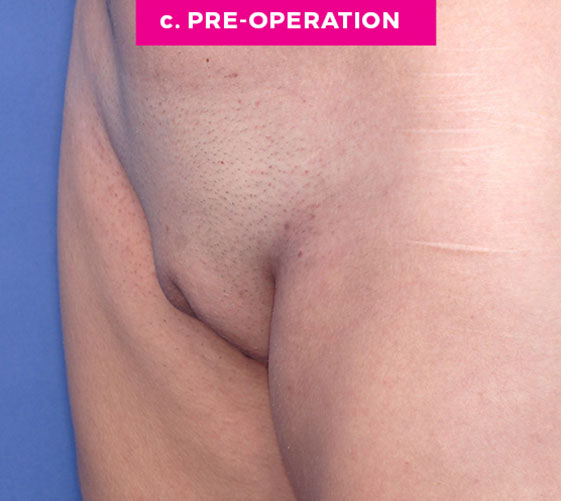 PUBIC MONS LIFT Patient 8 Before 2