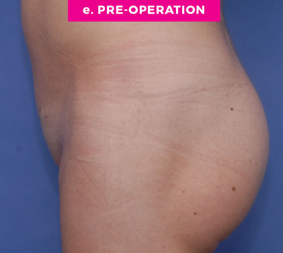 PUBIC MONS LIFT Patient 8 Before 3