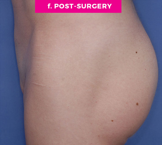 PUBIC MONS LIFT Patient 8 After 3