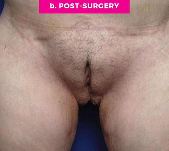 PUBIC MONS LIFT Patient 9 After