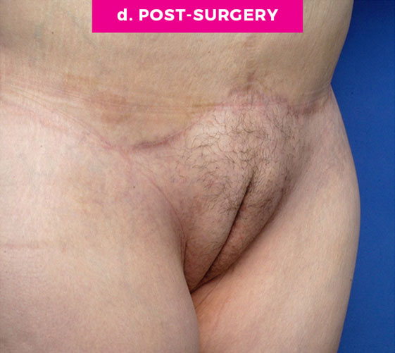 PUBIC MONS LIFT Patient 9 After 2