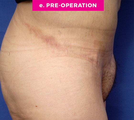 PUBIC MONS LIFT Patient 9 Before 3