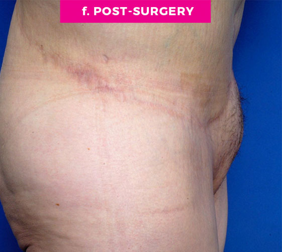 PUBIC MONS LIFT Patient 9 After 3