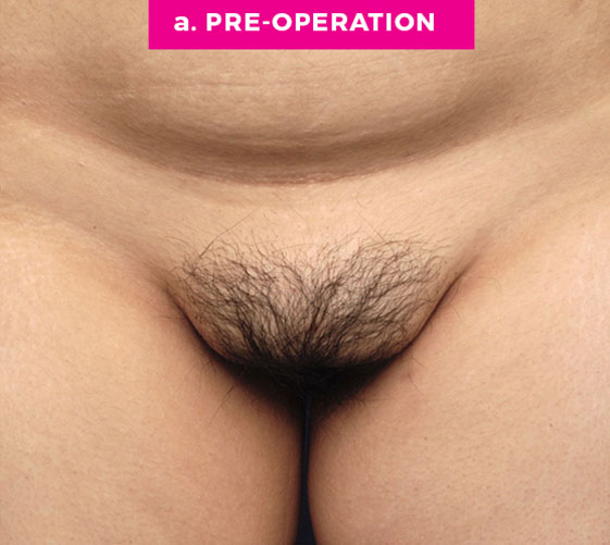 Pubic Mons Patient 1 Before
