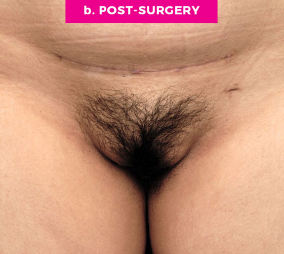 Pubic Mons Patient 1 After