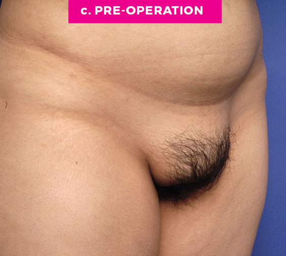 Pubic Mons Patient 1 Before Angle
